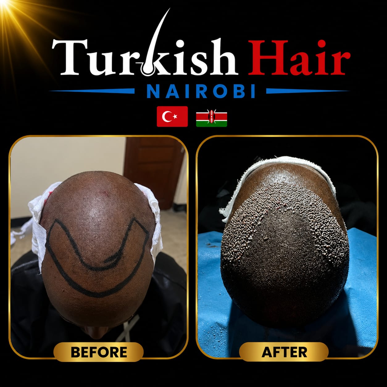 Turkish Hair Nairobi Case 5